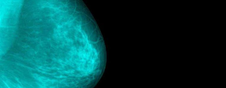 5 Signs & Symptoms Of Breast Cancer